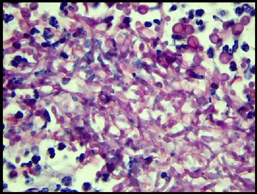 Candidiasis sistémica - <div style=